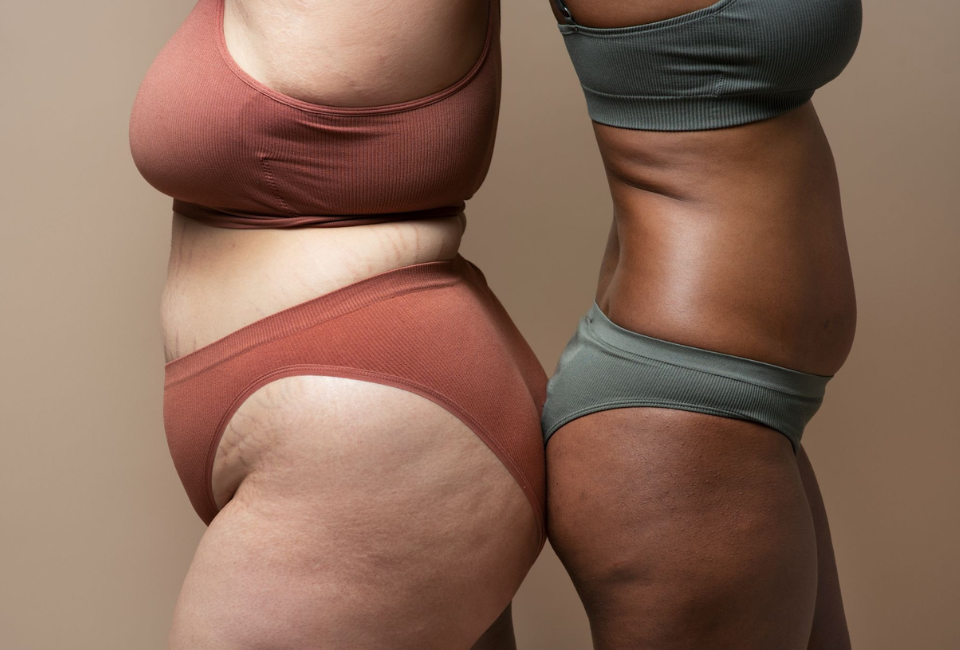 Duas mulheres em roupa interior, de costas uma para a outra com sinais de lipedema.